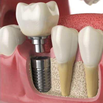 procedimento-implantodontia